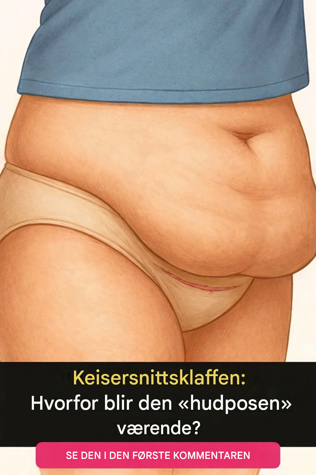 Keisersnittsflappen: Hvorfor den «posen» med hud blir igjen