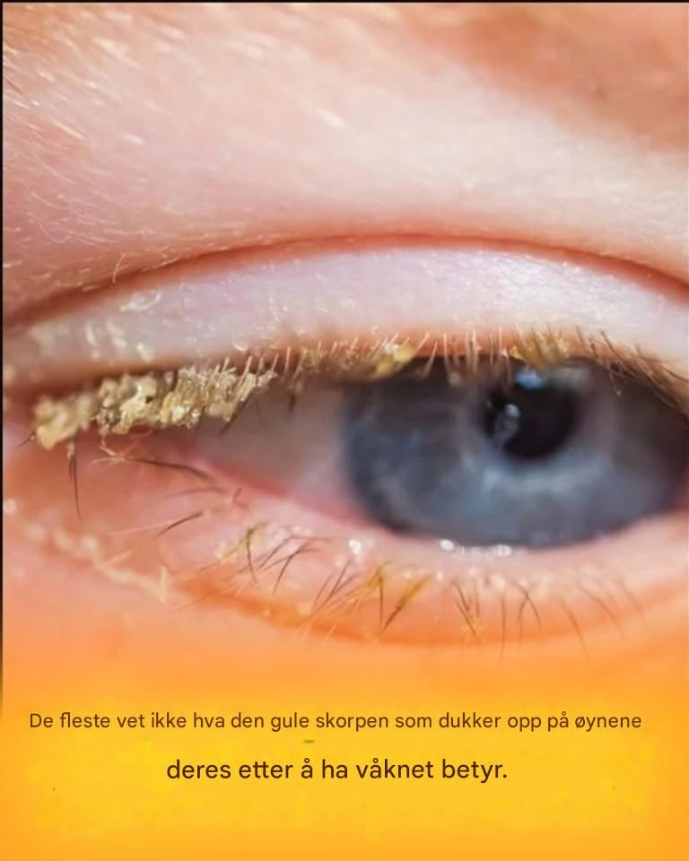 Gul skorpe etter å ha våknet: hva betyr det?